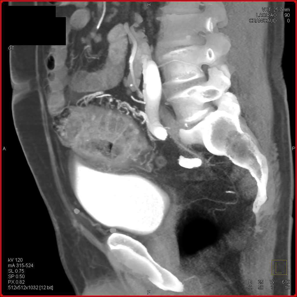 CT Cystogram with Colon Cancer Invading the Bladder ...