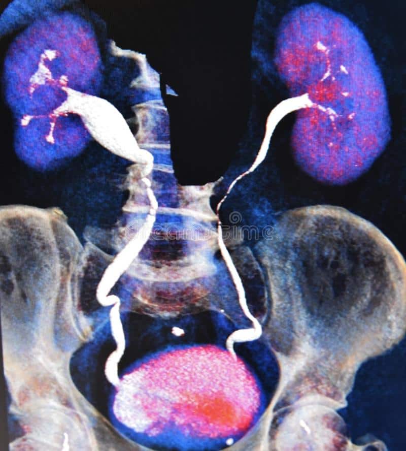 Ct Scan 3d Ct Urography Kidneys Bladder Colorful Stock Photo