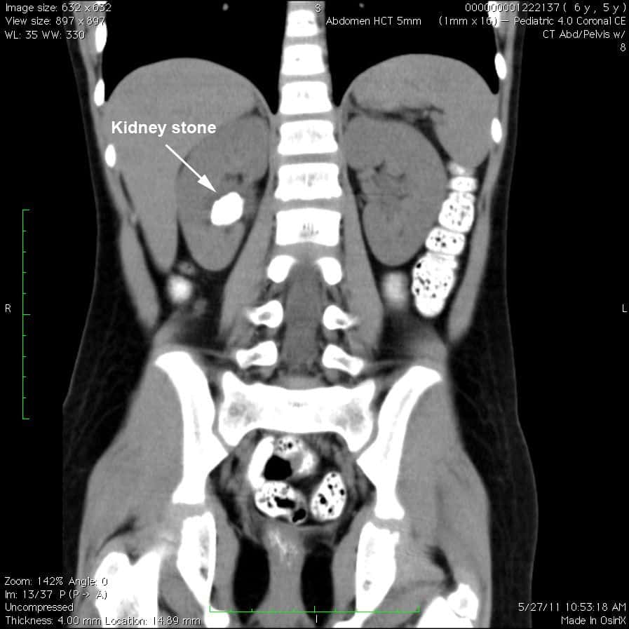 Ct Scan Of Kidney Ureter Bladder