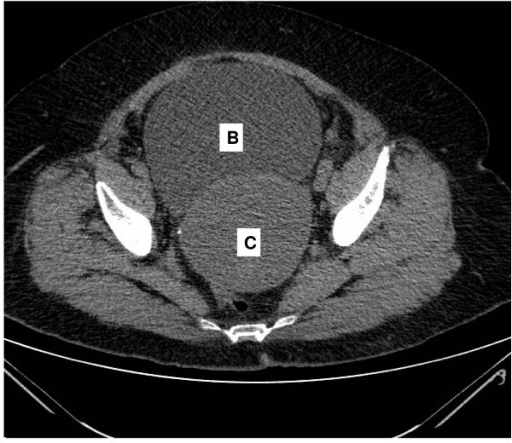 Ct scan of the abdomen reveals a distended urinary blad