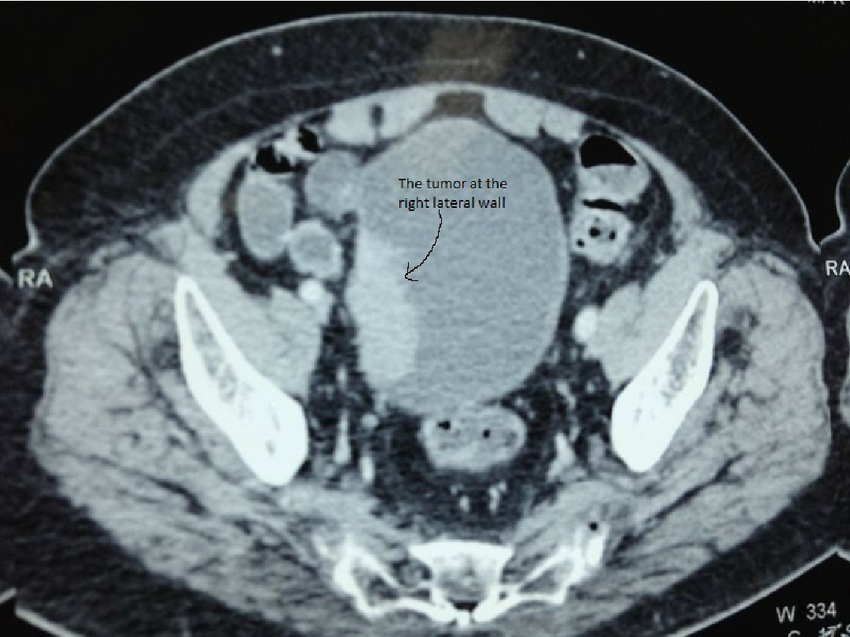 CT scan showing the location of bladder tumor.