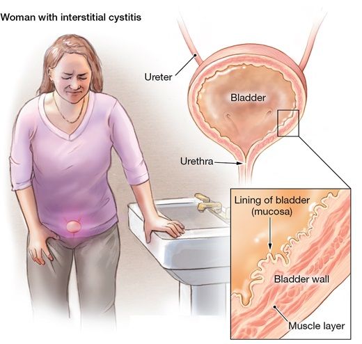 Cystitis is an inflammation of the bladder, which affects women five ...