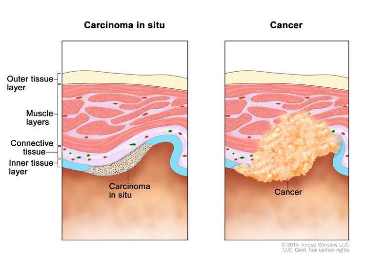 Definition of carcinoma in situ