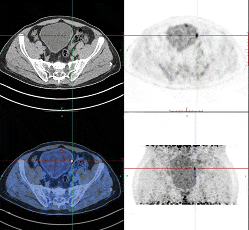 Delayed 18F FDG PET/CT Imaging in the Assessment of Residual Tumors ...