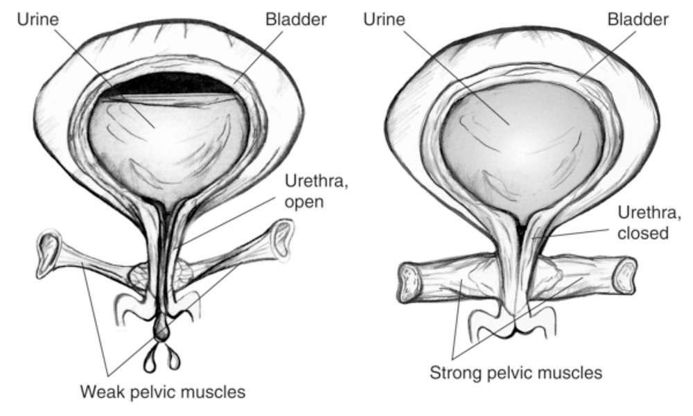 Do I Have An Overactive Bladder?