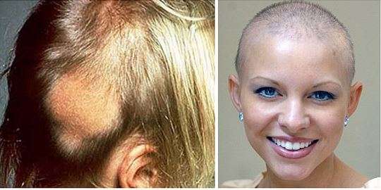 Does Hair Dye Cause Cancer? Bladder Cancer and Safe Hair ...