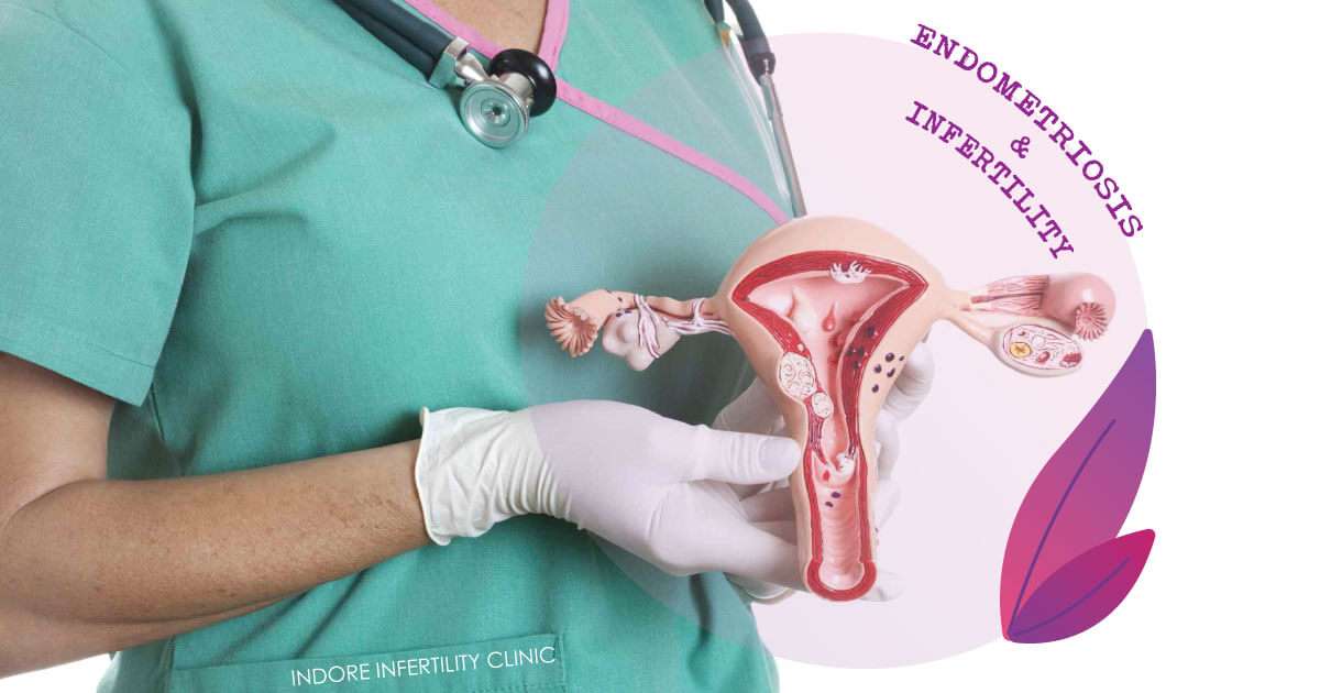 Endometriosis and Infertility