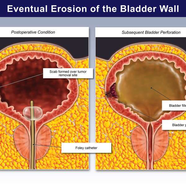 Eventual Erosion of the Bladder Wall