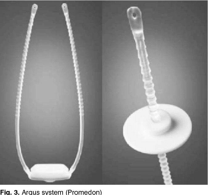 Figure 3 from Artificial urinary sphincter  new devices in male ...