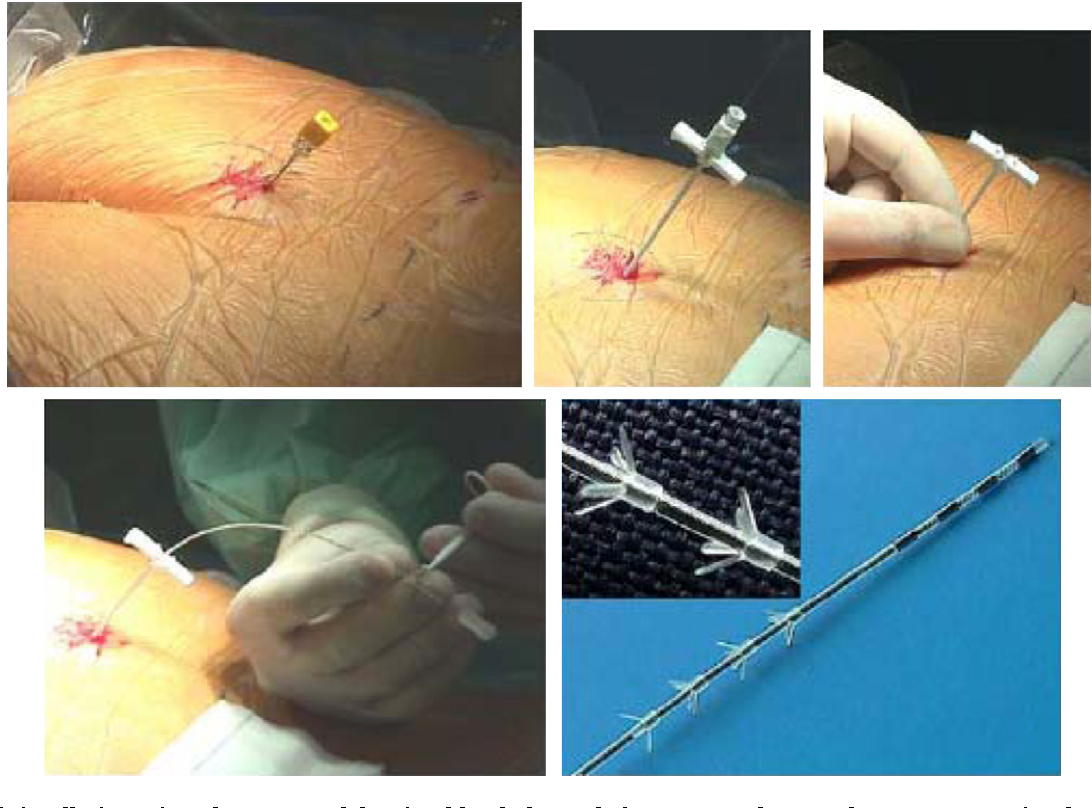 Figure 4 from Latest technologic and surgical developments in using ...
