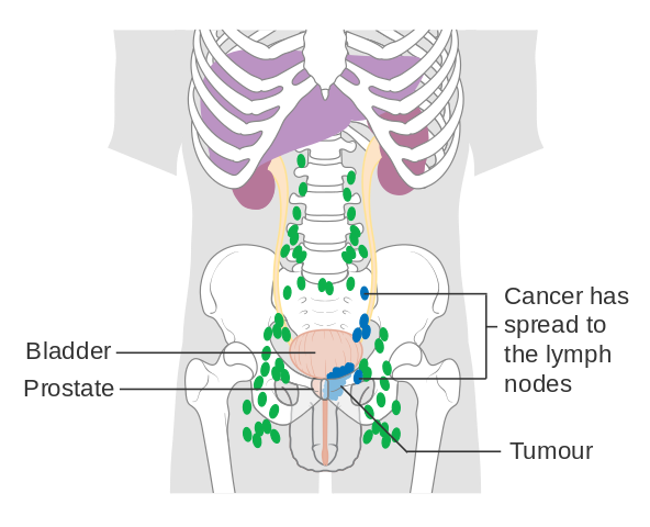 File:Diagram showing prostate cancer that has spread to the lymph nodes ...