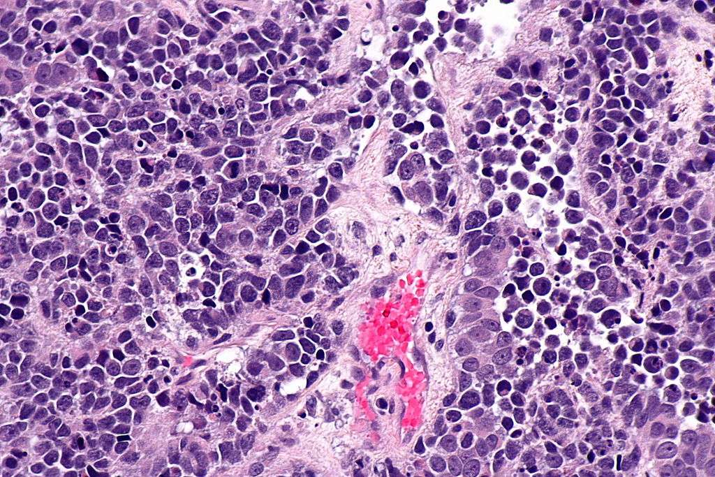 File:Small cell carcinoma of the urinary bladder