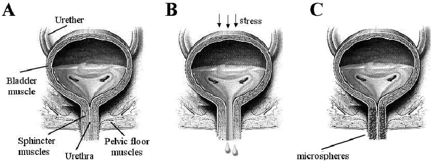 Front view of bladder. a) Strong sphincter and pelvic ...