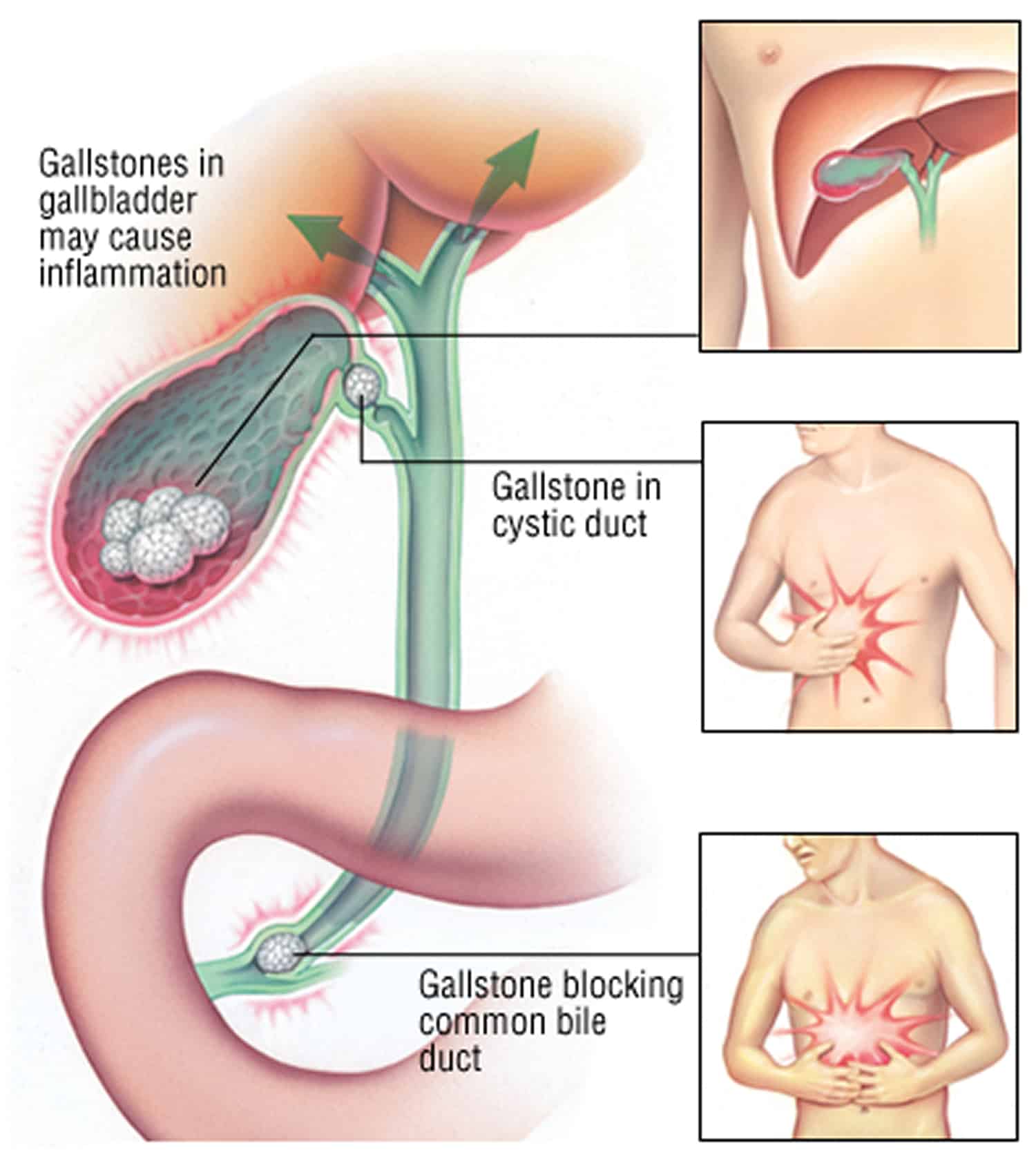 Gallbladder Pain &  Problems