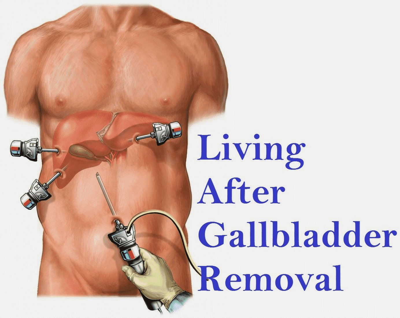Gallbladder Removal Surgery: Symptoms, Treatment, And Benefits