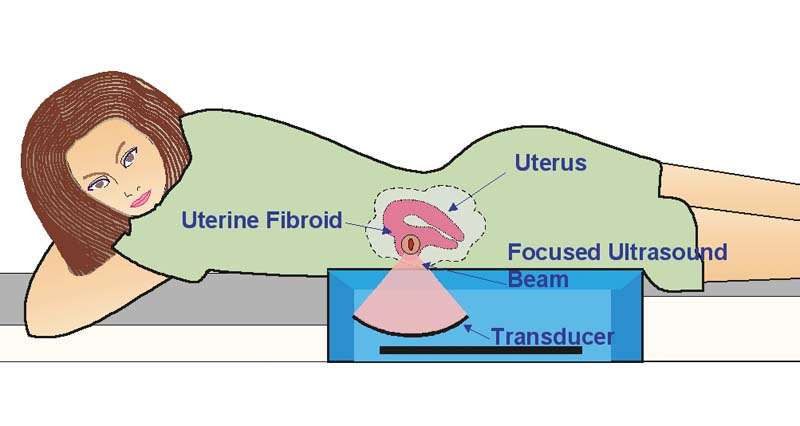 Gathering My Roses: Uterine Fibroids
