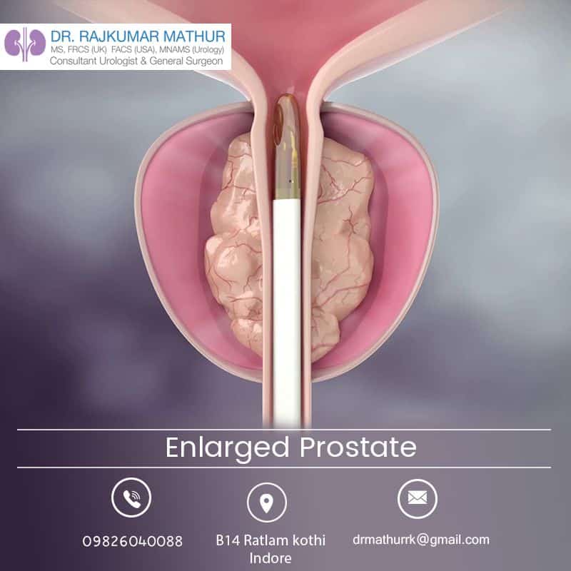 Get Your Enlarged Prostate treated by Dr. Rajkumar Mathur