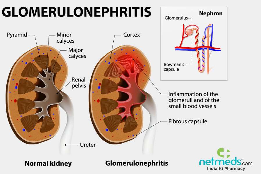 Glomerulonephritis: Causes, Symptoms and Treatment
