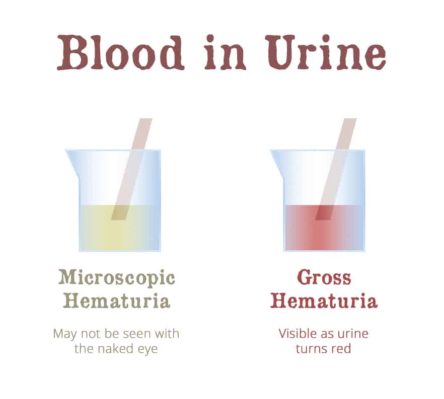 Hematuria Means Blood in Urine
