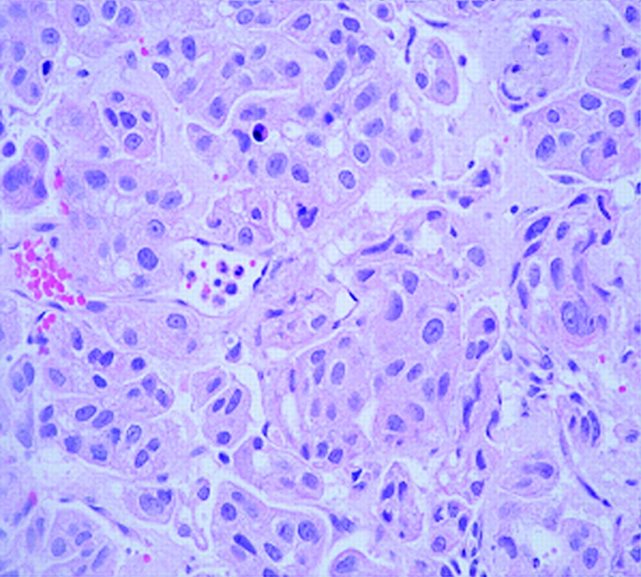 Herpetiform cutaneous metastases from transitional cell carcinoma of ...