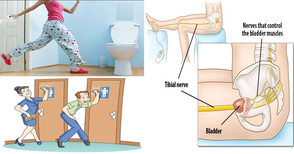 Home Remedies to Treat an Overactive Bladder Naturally