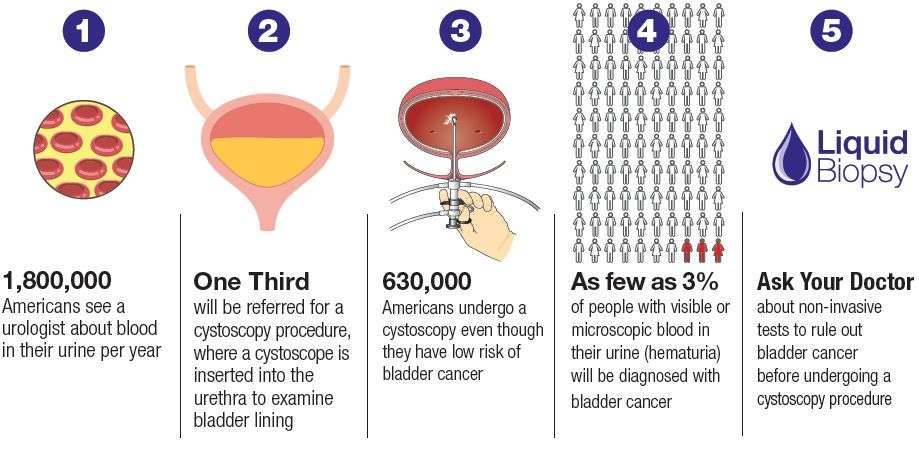 How Do You Test For Bladder Cancer