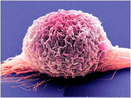 How Fast Does Bladder Cancer Grow