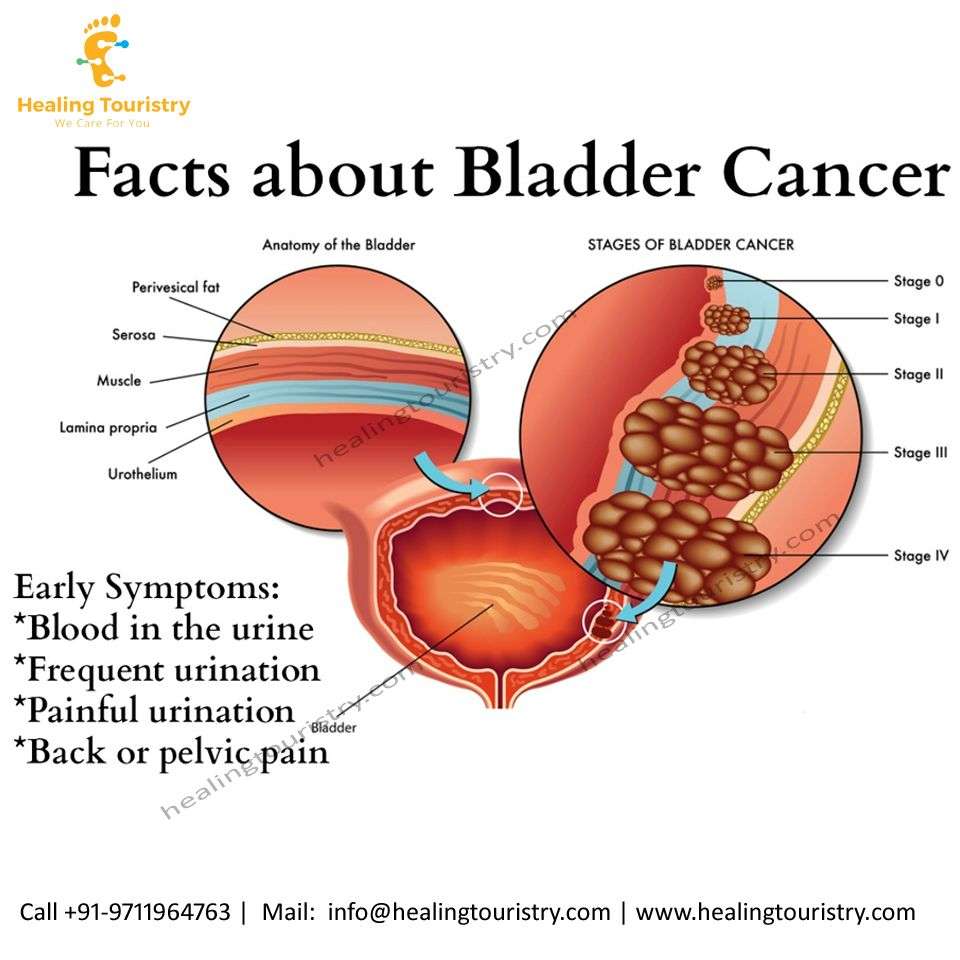 How Long Can You Live With Bladder Cancer