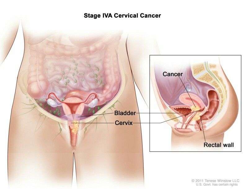 How Long Can You Live With Metastatic Bladder Cancer ...