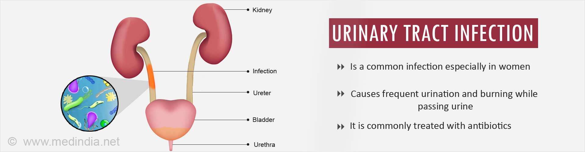 How to Prevent Urinary Tract Infection Recurrence Without ...