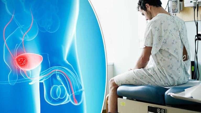 How To Test For Bladder Cancer