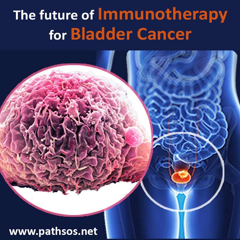 Immunotherapy for Bladder Cancer