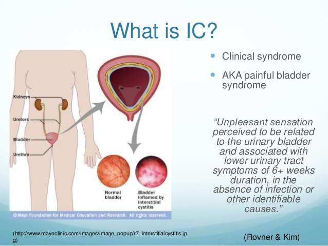 Interstitial Cystitis Painful Bladder Syndrome