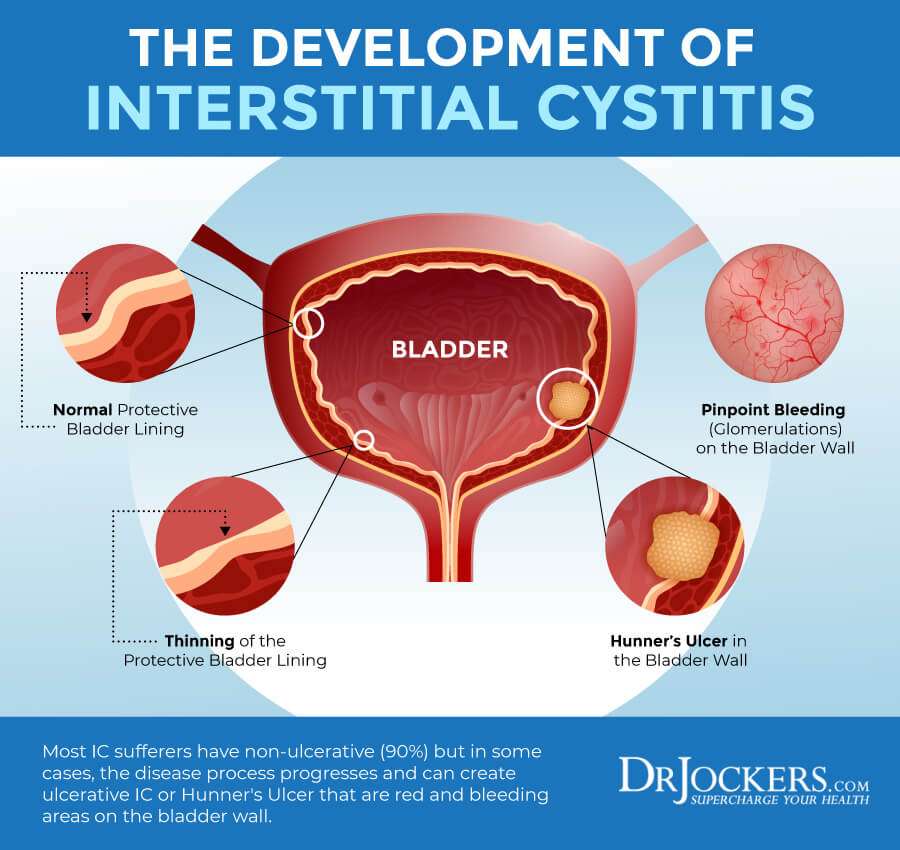Interstitial Cystitis: Symptoms, Causes and Support Strategies