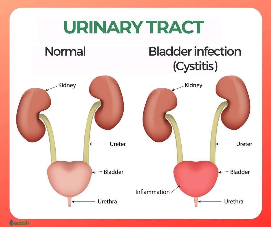 Is Cystitis A Bladder Infection
