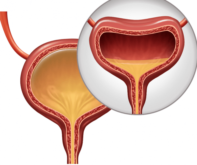 Is it Overactive Bladder or Stress Urinary Incontinence?