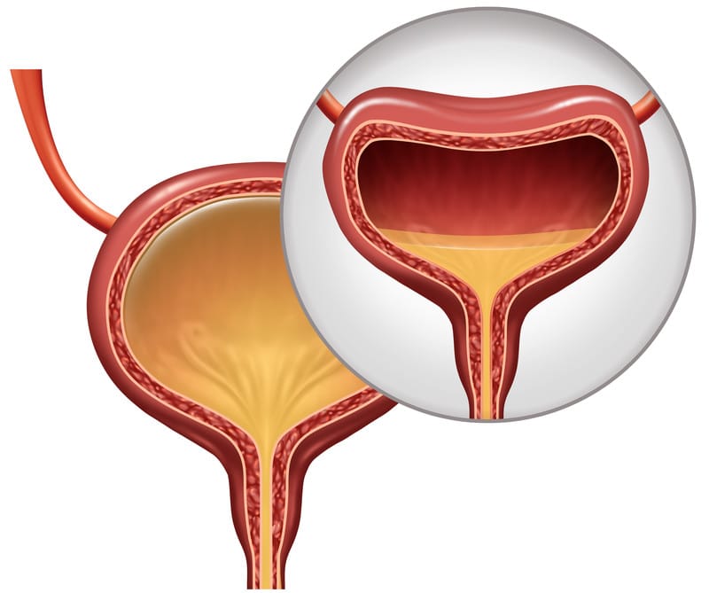 Is Overactive Bladder Caused by High Blood Sugar and Belly Fat?