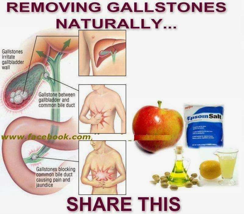 Jameel Aahmed Milansaar: Removing Gallstones Naturally