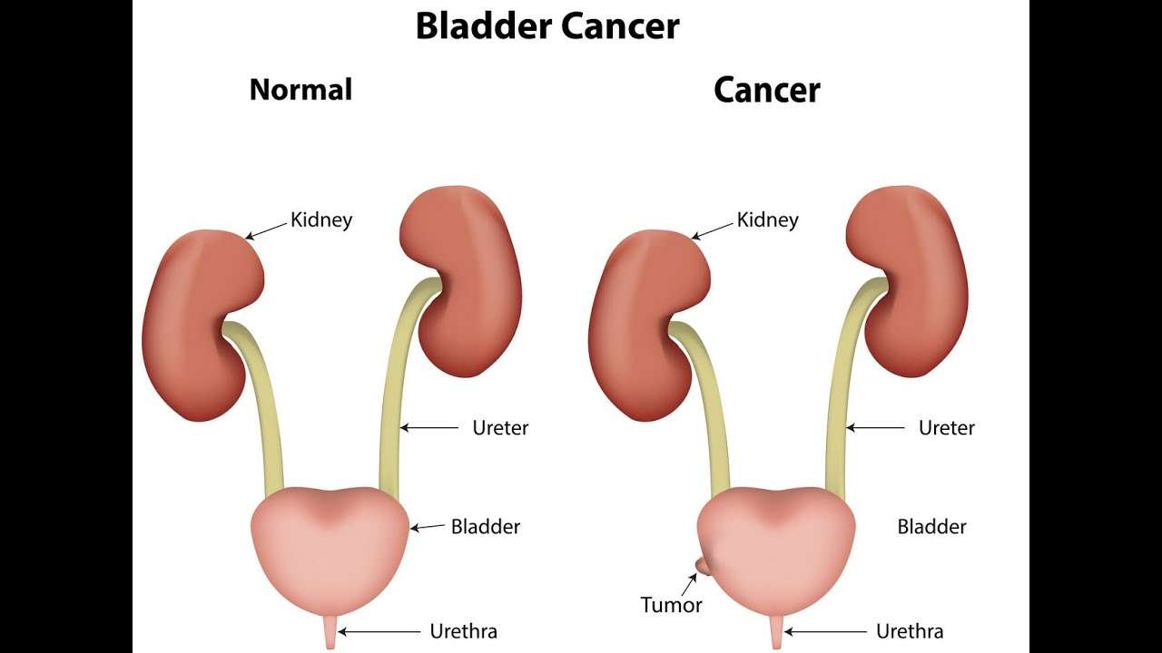 Kidney Cancer Symptoms Causes