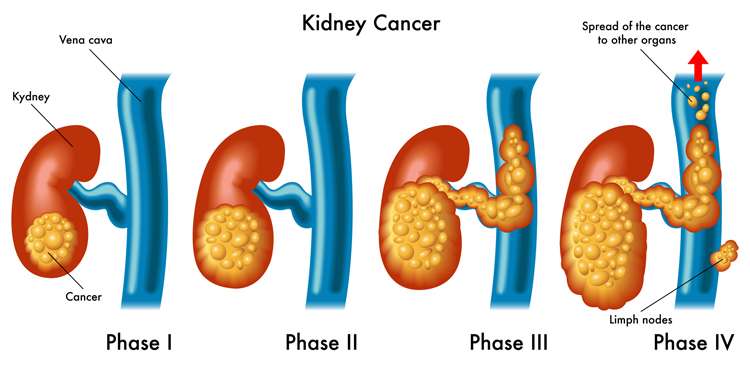 Kidney Cancer Symptoms Usually Occur Later Rather Than ...
