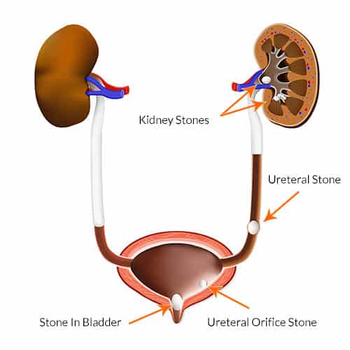Kidney Stone Overview, Symptoms, Diagnosis &  Treatment Options