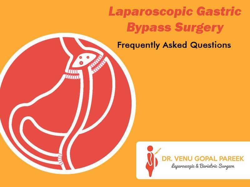 Laparoscopic Gastric Bypass Surgery: Frequently Asked ...