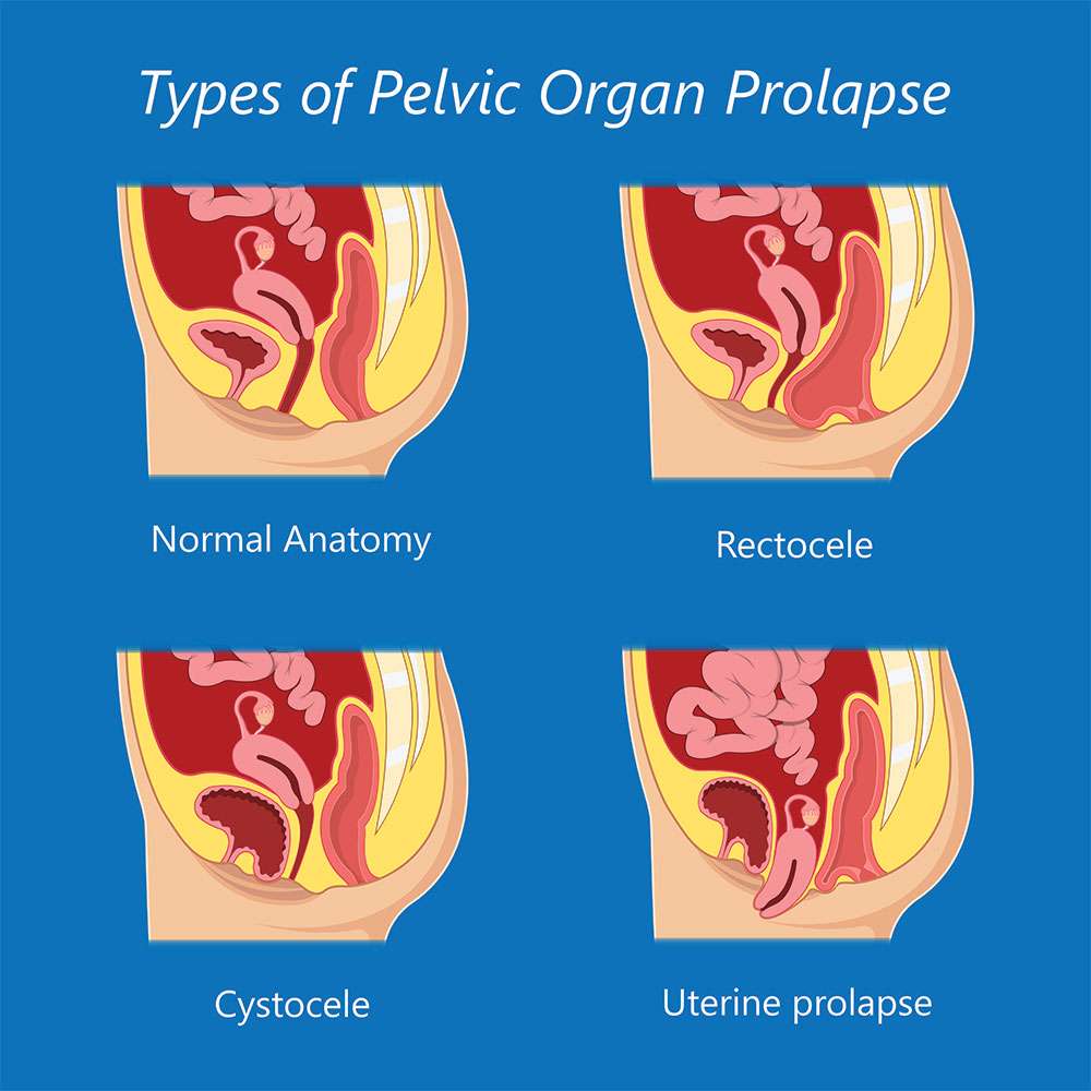 Life after pelvic organ prolapse surgery: a guide to ...
