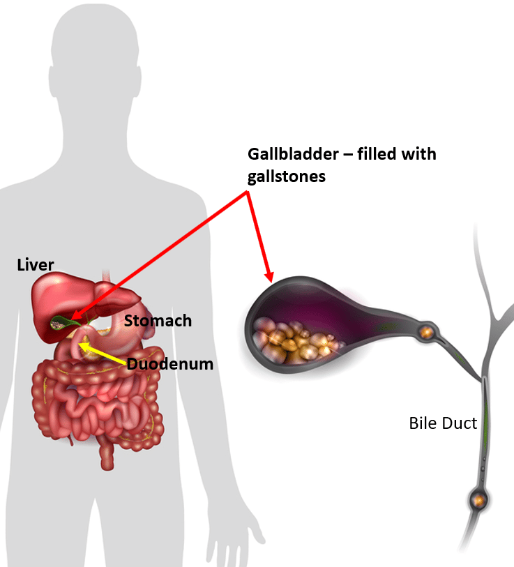 Life Without a Gallbladder