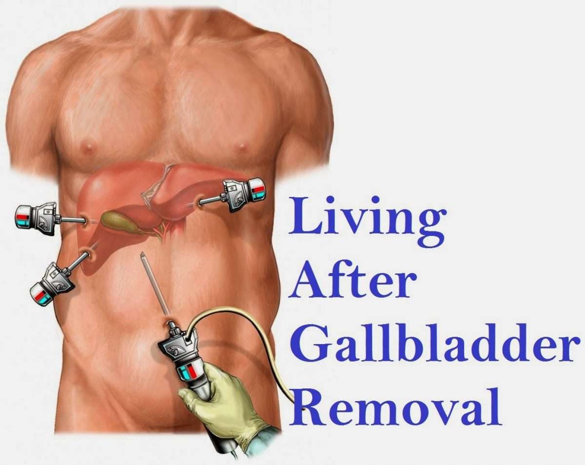 Living After Gallbladder Removal