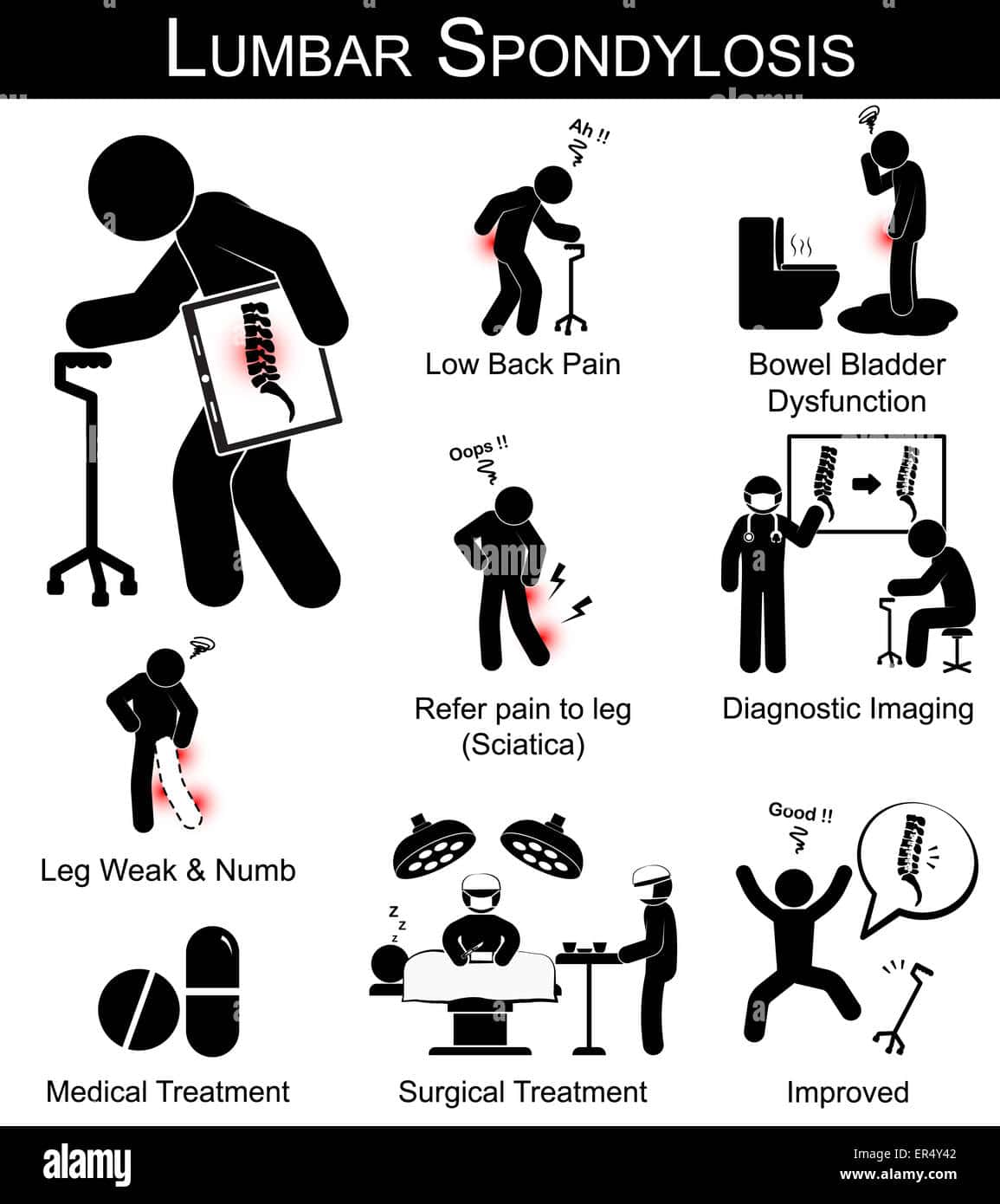 Lumbar Spondylosis symptoms pictogram ( Low back pain , refer pain to ...