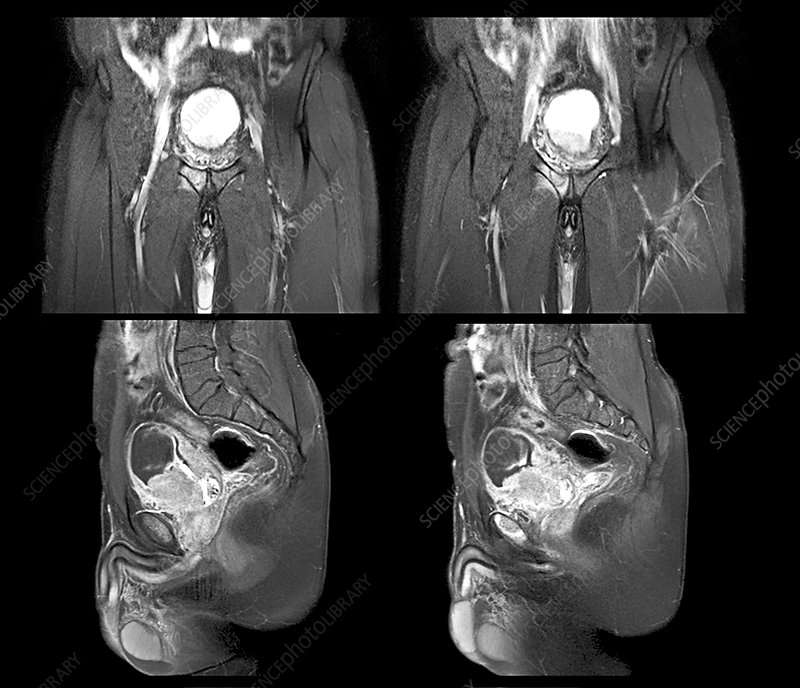 Metastatic bladder cancer, MRI