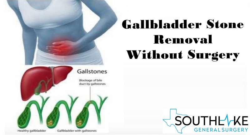 Myths and Reality of Gallstone Treatment and Gallbladder Removal