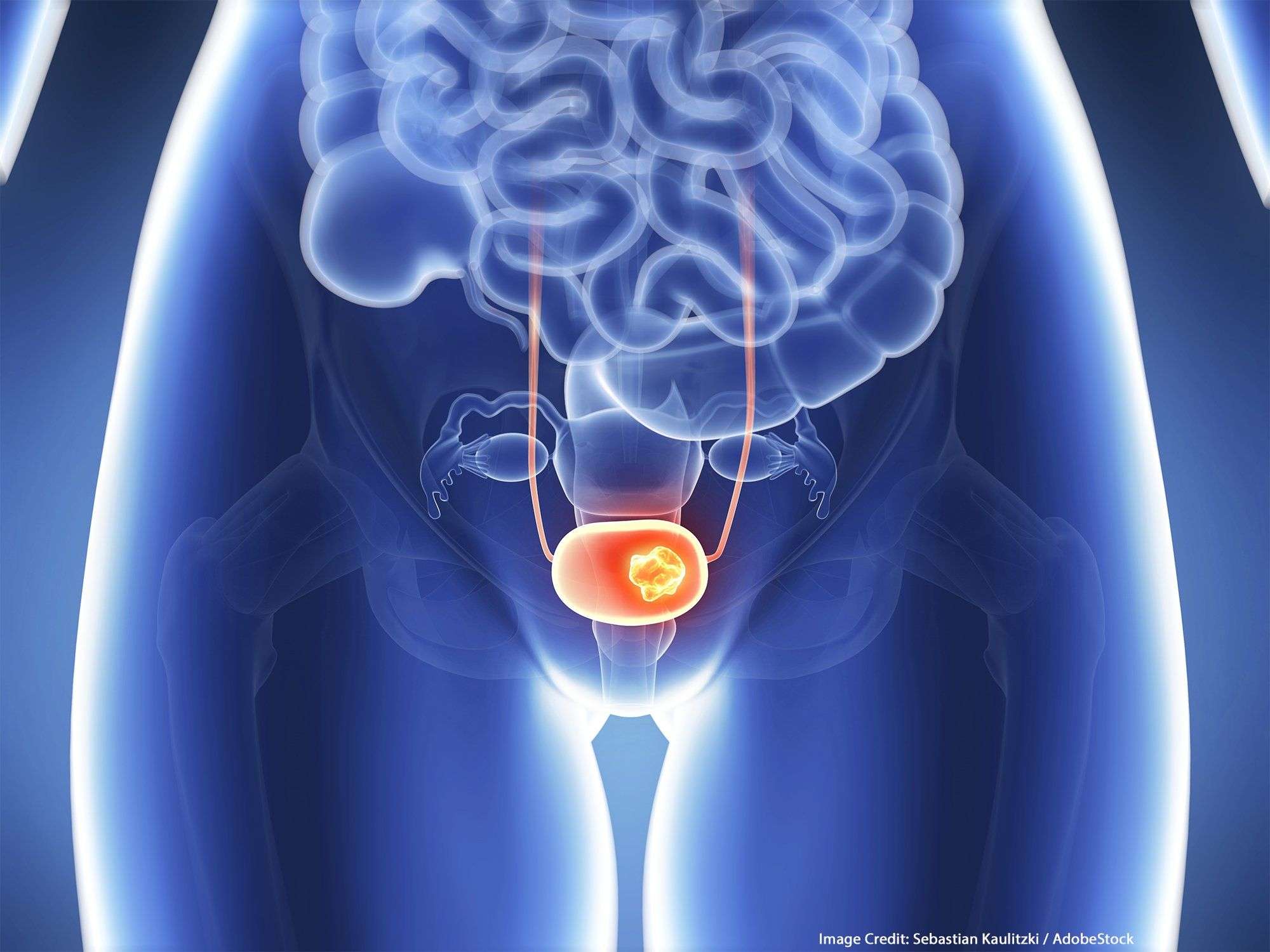 NCCN: New Bladder Cancer Guidelines Include Updated ...