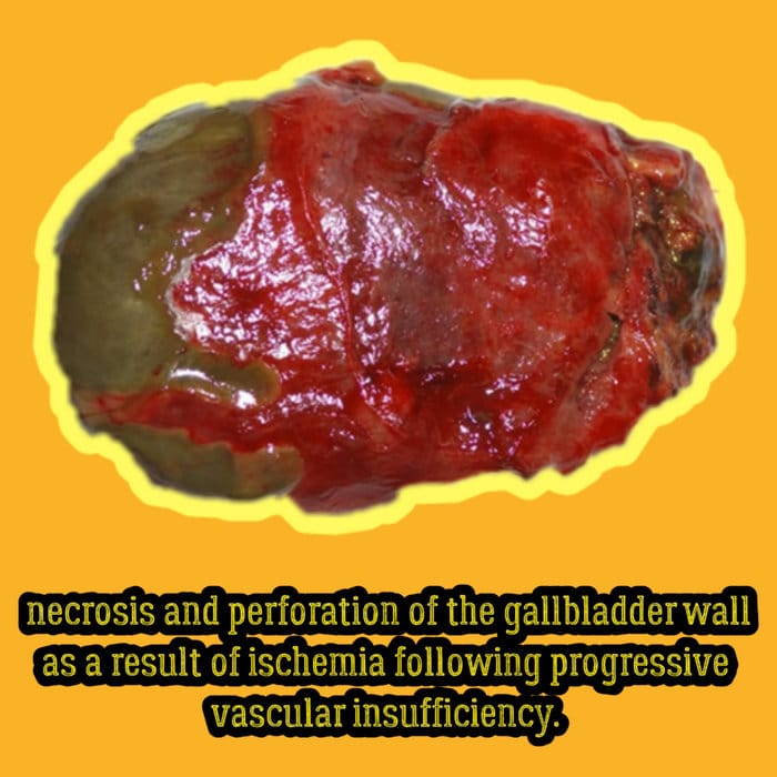 Necrosis and Perforation of the Gallbladder Wall as a Result of ...